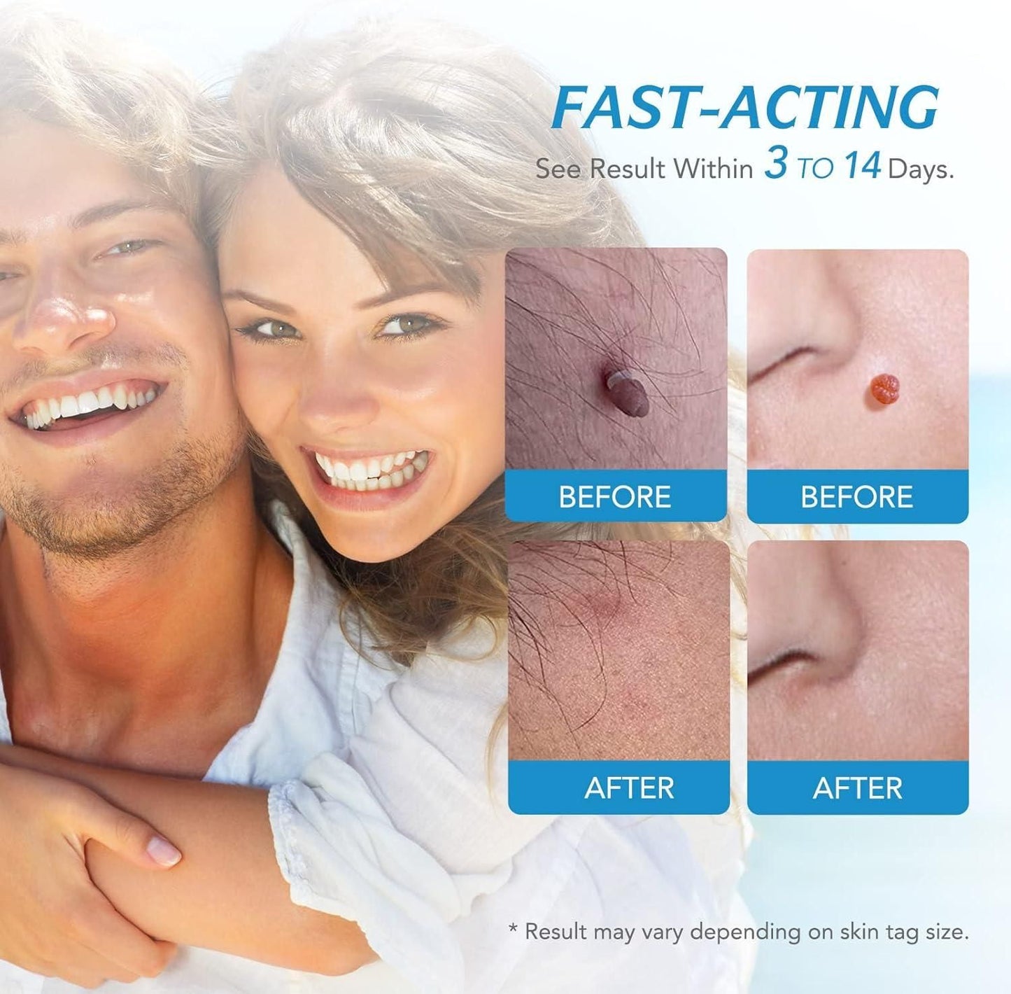 2 in 1 Skin Tag Remover Kit