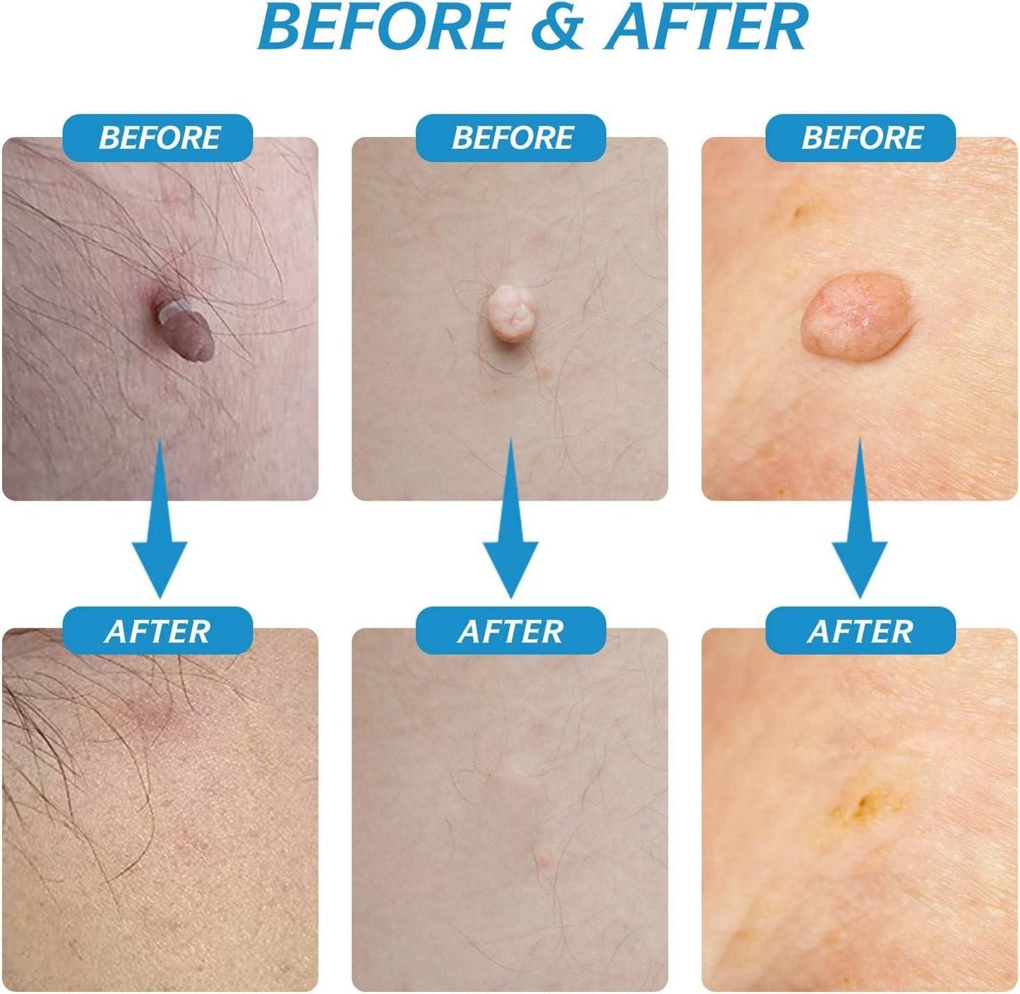 2 in 1 Skin Tag Remover Kit